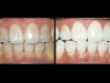 aacd_photo_of_teeth_whitening